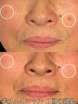 サロン ド マキ(Salon de Maki)/気軽にシミケアができる時代です