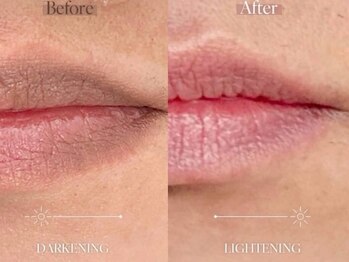 ジジベレッザ 芦屋店(jiji belleza)/lemella (ルメラ)/最新韓国美容