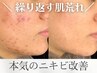 ＜ニキビ悩み｜初回限定4回セット＞徹底ニキビケアコース｜ハーブピーリング