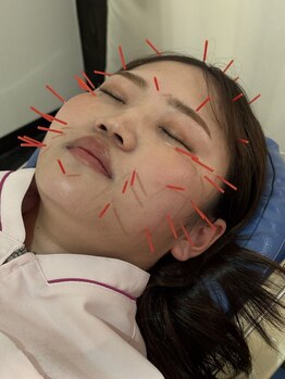 名古屋ハピネス鍼灸接骨院丸の内の写真/【たるみ・むくみ改善＆美肌効果も】女性におすすめ!!リフトアップ美容鍼☆老廃物の排出を促進◇