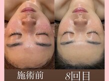 ウィズルーチェ 麻布十番店(with luce)/20代/肌改善3ヶ月