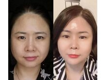 ステップイン(Step in)/ダイヤモンドピールプログラム