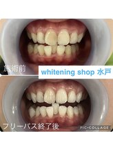 ホワイトニングショップ 水戸駅前店/#水戸ホワイトニング#水戸エステ