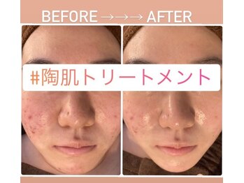 アレーズファイブフォー(A’LAISE54)/ニキビケア