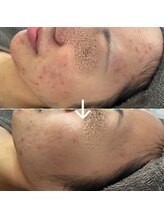 ブルームーン(Blue Moon)/リベルハーブピーリング　５回