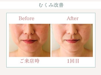 トータルビューティー ゆみえエステ(Total Beauty)/ハイパーナイフ フェイシャル