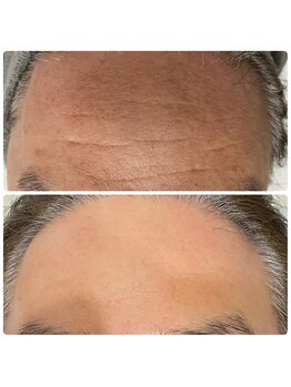 武蔵小杉リンパサロン かおりの部屋/水光ボツリヌスフェイシャル