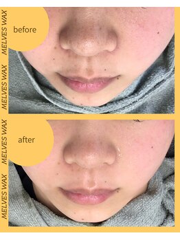 メルベスワックス(MELVES WAX)/フェイスダブル脱毛