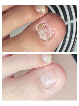 トラブルネイルケア