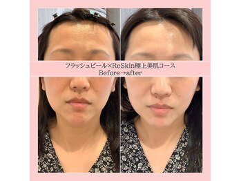 ディアメ(Diame)/くすみ・ざらつきケアに♪