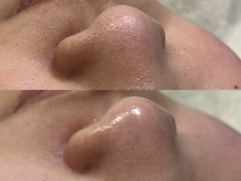 アルム(a'lm)/WAX脱毛/産毛・毛穴・黒ずみ変化