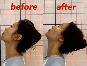 プーラビタ(PURAVITA)/首こり可動域改善 before after