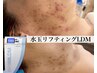 ニキビが気になる方は。｜水玉リフティングLDM初回体験