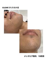 クリア(CLEAR)/メンズヒゲ脱毛　13回目
