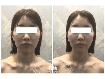 美極 トータルビューティー(美極 TOTAL BEAUTY)/恵比寿/小顔コルギ/エステ
