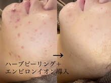 シュリー(Sriii)/ハーブピーリング＆エンビロン