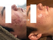 ビューティーマックス(Beauty Max)/フェイシャルbefore→after3ヶ月