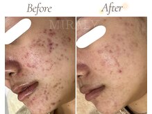 ミラリー(MIRALY)/赤み・ニキビケア 5ヶ月(10代)