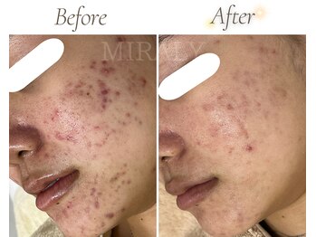 ミラリー(MIRALY)/赤み・ニキビケア 5ヶ月(10代)