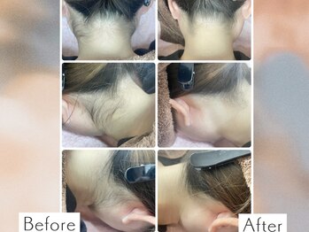 ディオーネ 上越南高田店(Dione)/うなじ脱毛