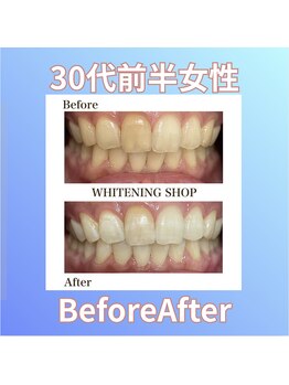 ホワイトニングショップ 西原店/30代前半女性☆BeforeAfter