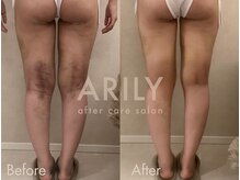 アリリィ(ARILY)/ダウンタイムケア/表参道/外苑前