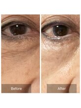 グリーンノート(GREEN NOTE)/ヒト幹細胞培養液65％2回目施術