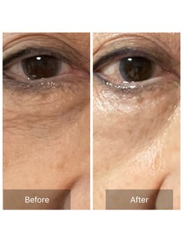 グリーンノート(GREEN NOTE)/ヒト幹細胞培養液65%2回目施術