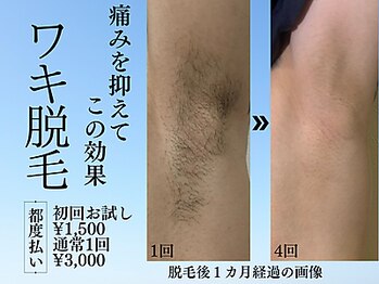 アンジェリーナ/メンズフラッシュ脱毛/都度払い