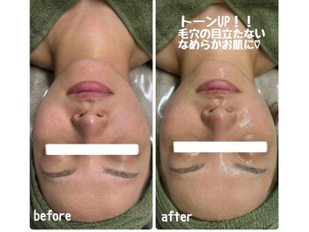 クラリ(Clari)/毛穴/毛穴洗浄/ハイドラ