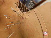 はりきゅう和 ルート鍼灸院/首肩のひどいコリ