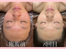 ウィズルーチェ 麻布十番店(with luce)/２０代　肌改善　３ヶ月