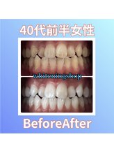 ホワイトニングショップ 西原店/40代前半女性☆BeforeAfter