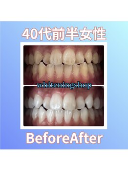 ホワイトニングショップ 西原店/40代前半女性☆BeforeAfter