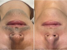ミーエイト(Mii∞)の雰囲気（大人気メンズ全身脱毛★1回目から効果を実感！冷却で痛みも軽減）