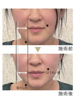 エムドット(M.)/ほうれい線にはエアバリ★