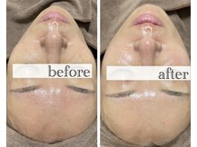 アンドエスビューティ(&S Beauty)/乳酸ピーリング