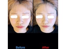 美容矯正サロン レレポノ(LELEPONO)/小顔矯正ビフォーアフター