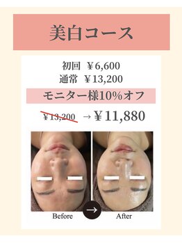 ナーズ(NAZ)/美白コース