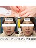 【口コミ投稿限定価格♪】美容鍼＋小顔矯正＋頭蓋骨矯正￥10000→￥6500