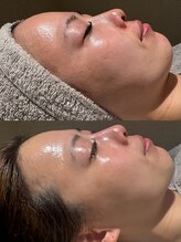 ウルソワン 都島店(/ulu soin)/花粉での肌荒れ改善2