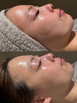 ウルソワン 都島店(/ulu soin)/花粉での肌荒れ改善2