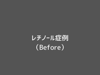 オアシスラグーン(OASIS LAGOON)/レチノールトリートメント