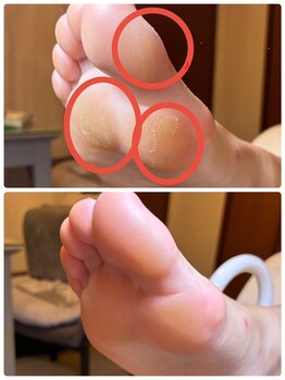 たこケア+足裏角質ケア