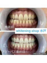 ホワイトニングショップ 水戸駅前店/#水戸ホワイトニング#水戸エステ