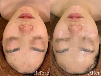 ビューティ ワンド ユズ(Beauty Wand YUZZ)/幹細胞ハーブピーリング 6回