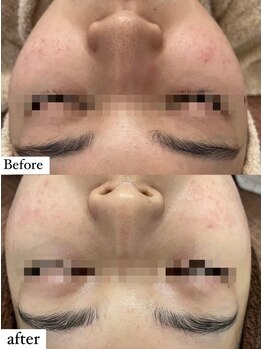 キュル(Kyul)/REVIハーブピーリング