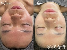 サロンドエテ(salon de ete)/ごわつき、美白と小顔