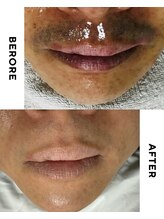 ゼロ 水戸店(ZERO)/ヒゲ脱毛★before&after