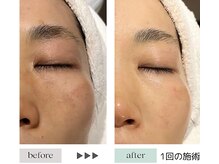 ジェニックサロン グランギンザ 水戸(GENIC SALON GRAND GINZA)/最新リフト/シミ/赤み/くすみ